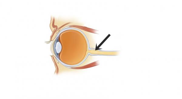 1629759690 295 Strabismus kissoilla