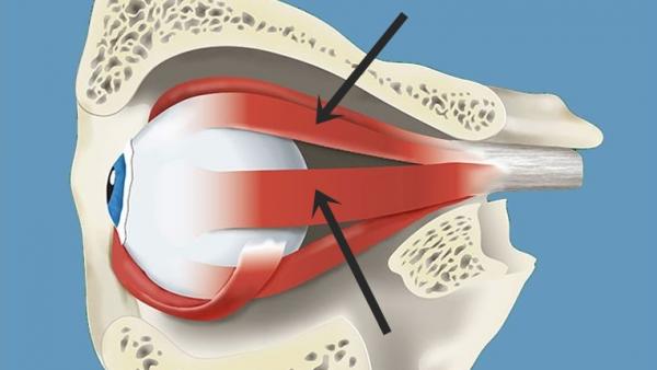 1629759690 303 Strabismus kissoilla